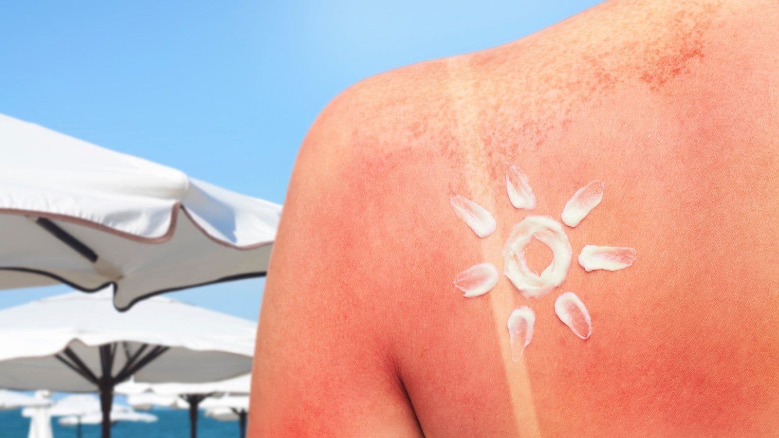 Épaule marquée par le soleil, médicaments photosensibilisants