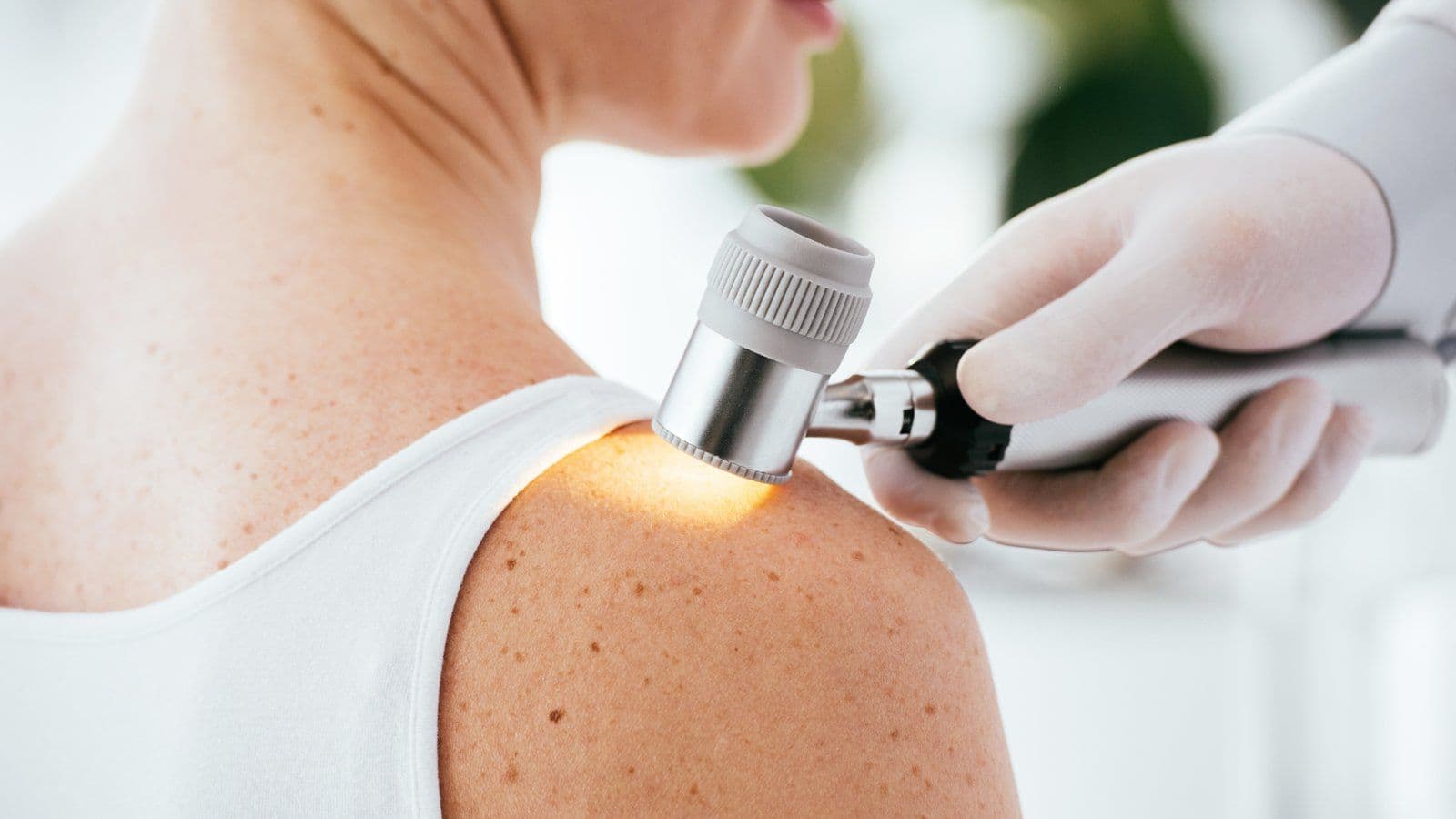 Examen d'une lésion cutanée au dermatoscope