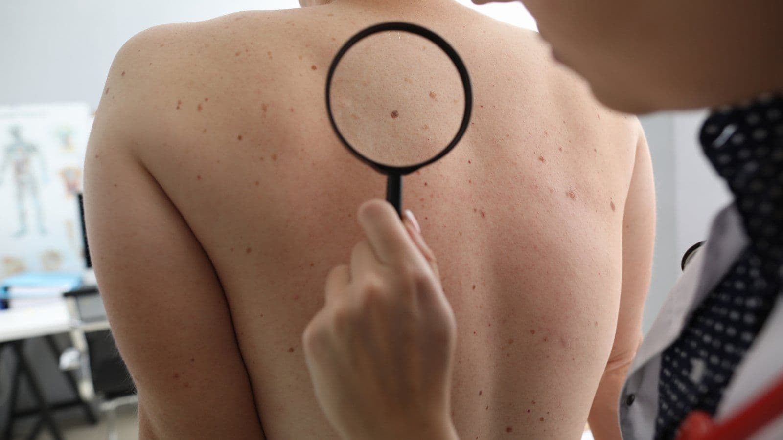 Auto-examen des grains de beauté du dos à la loupe